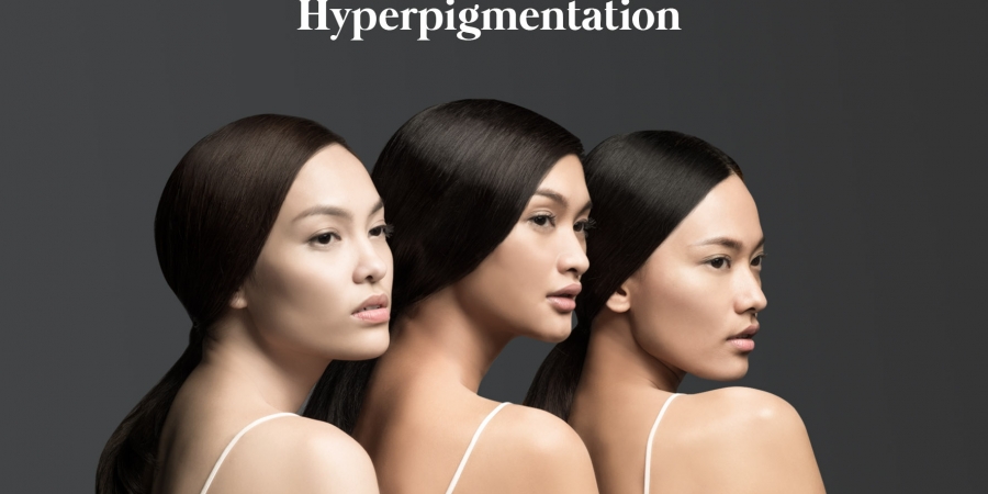 4 Types of Hyperpigmentation